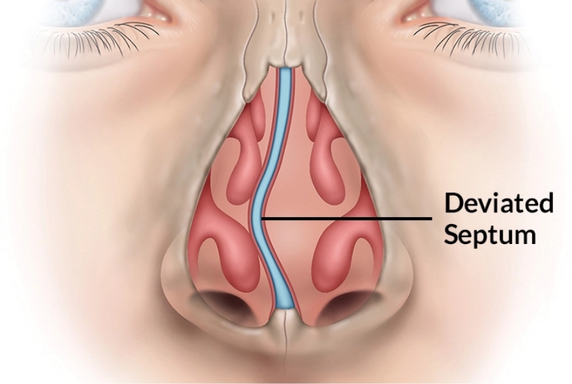 Close up of Nasal Structure with a Deviated Septum