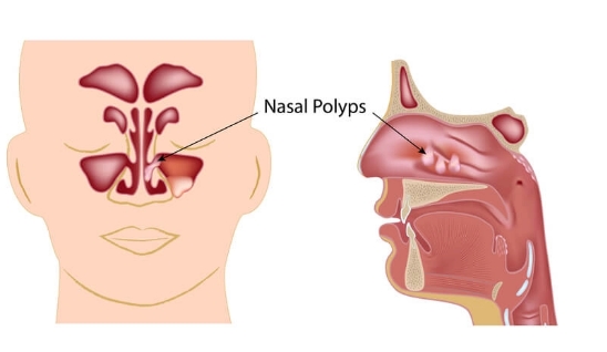 Front and side face views of the internal structure of the nose with nasal polyps pointed out in each.