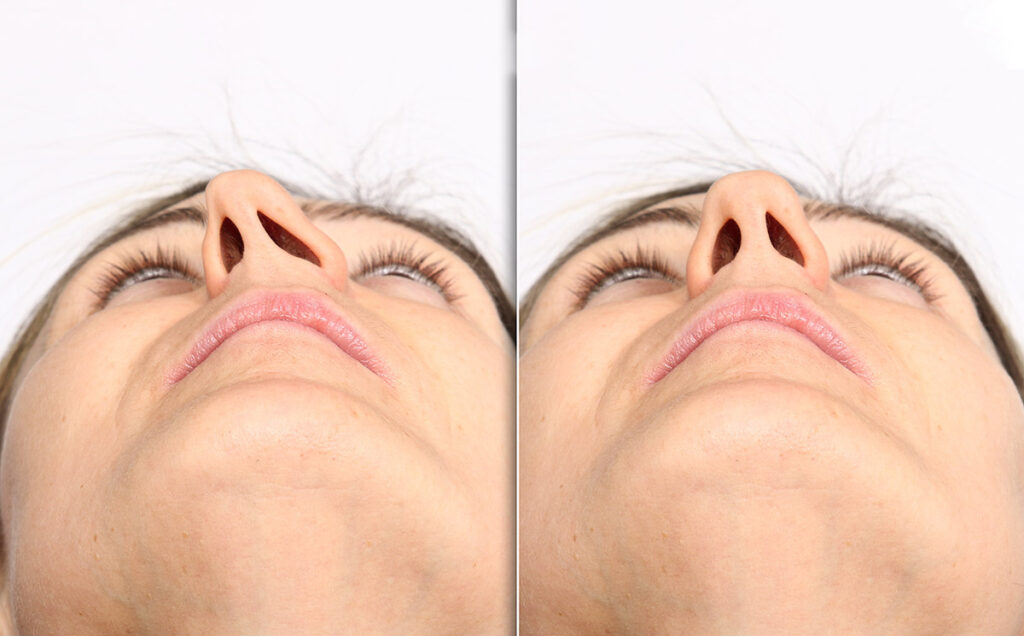 Deviated nasal septum before and after septoplasty surgery comparison.