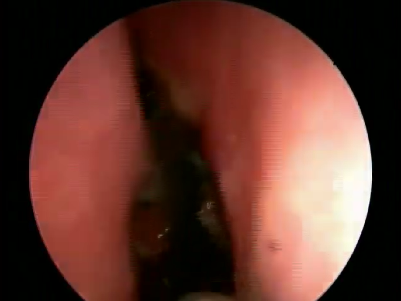 2nd post op visit nasal endoscopy after CSF leak repair thumbnail image.