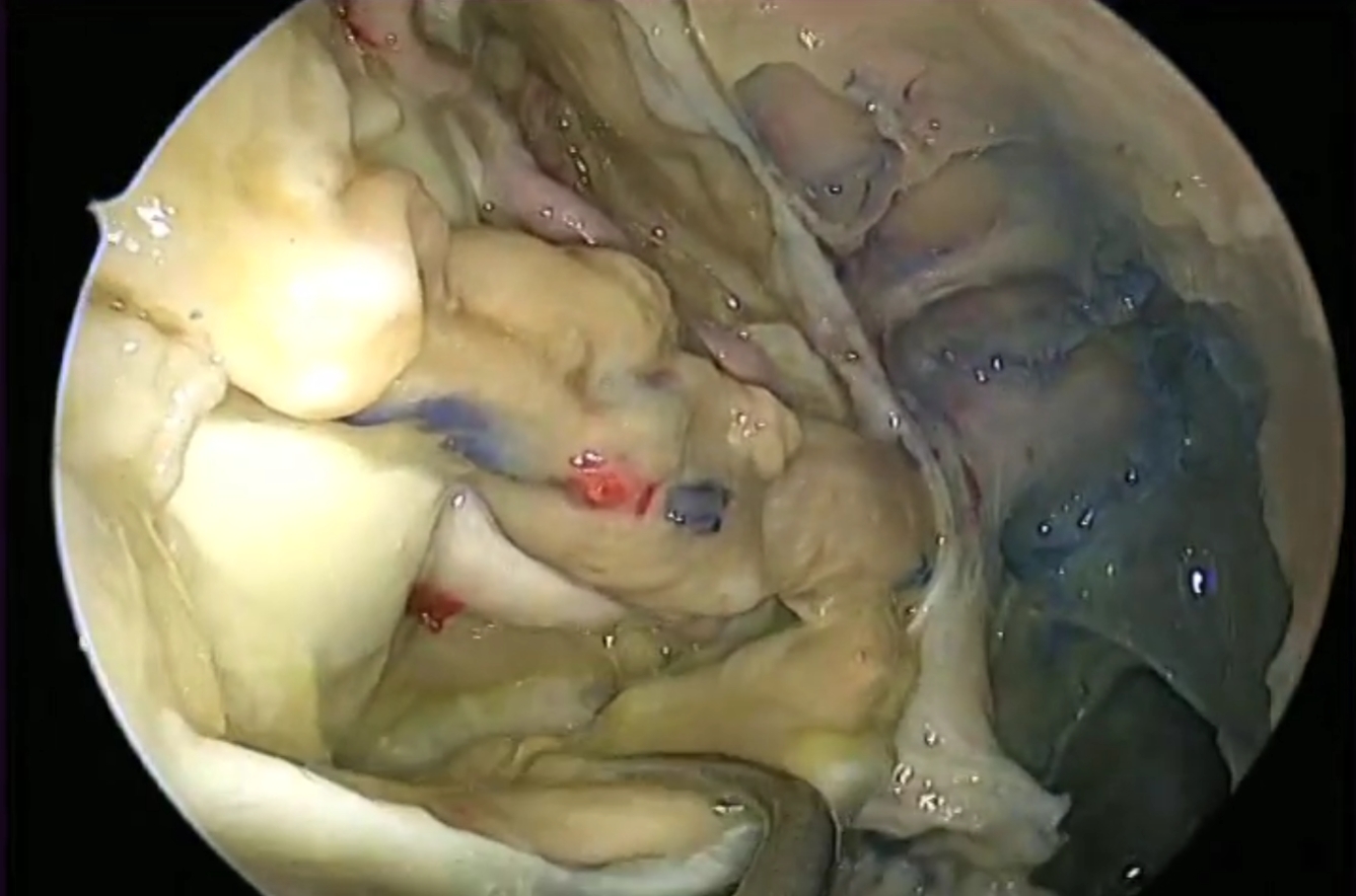 Cadaveric Orbit anatomy and optic nerve decompression demonstration video thumbnail.