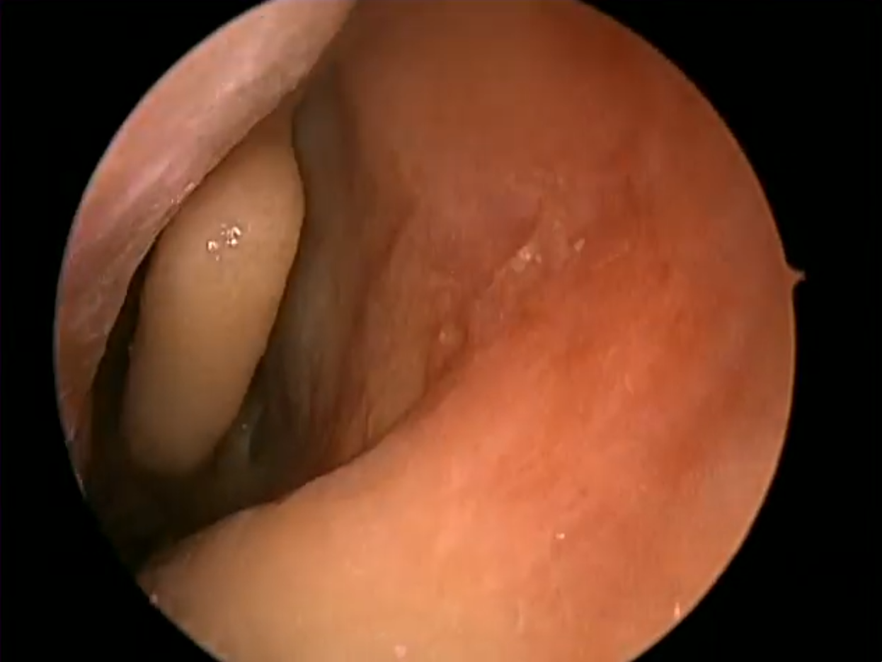 Cadaveric Sinus Surgery Demonstration video thumbnail.