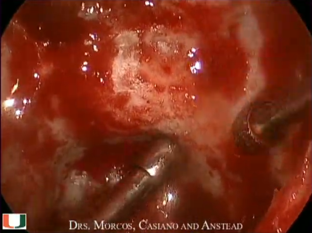 Endoscopic craniopharyngeoma resection video thumbnail.