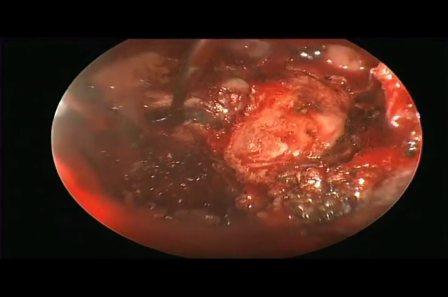 Endoscopic resection chordoma video thumbnail.