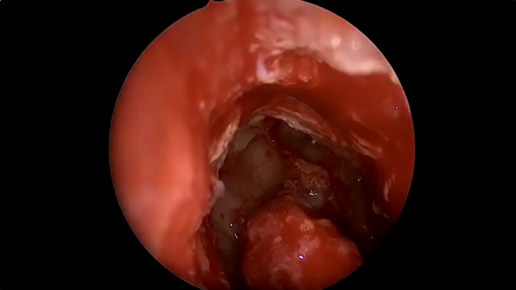 Frontal sinus surgery of the Lothrop video thumbnail.