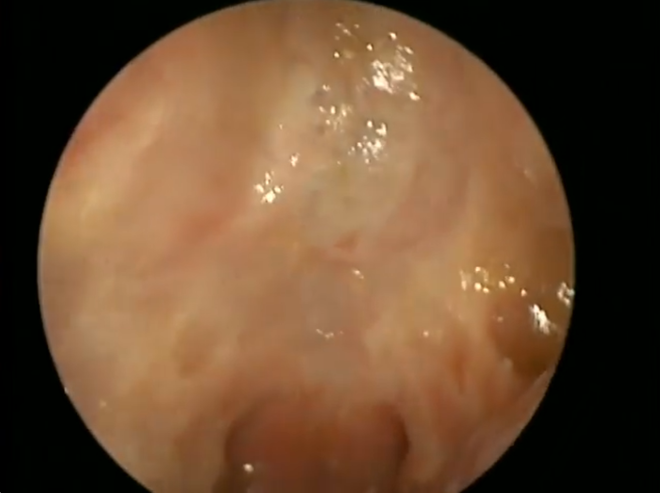 Video - Healed Anterior Skull Base Resection
