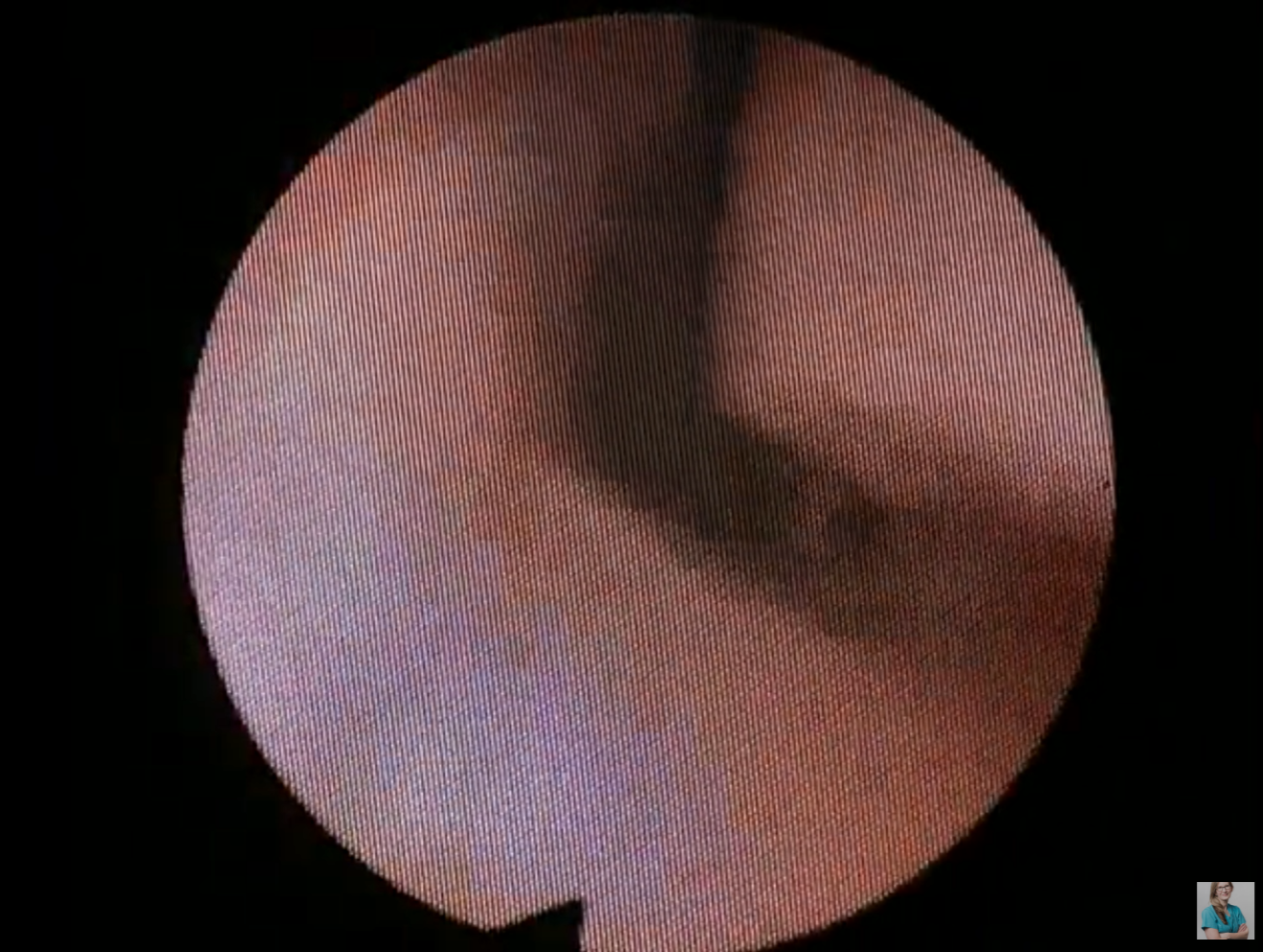 Video - Nasal Endoscopy