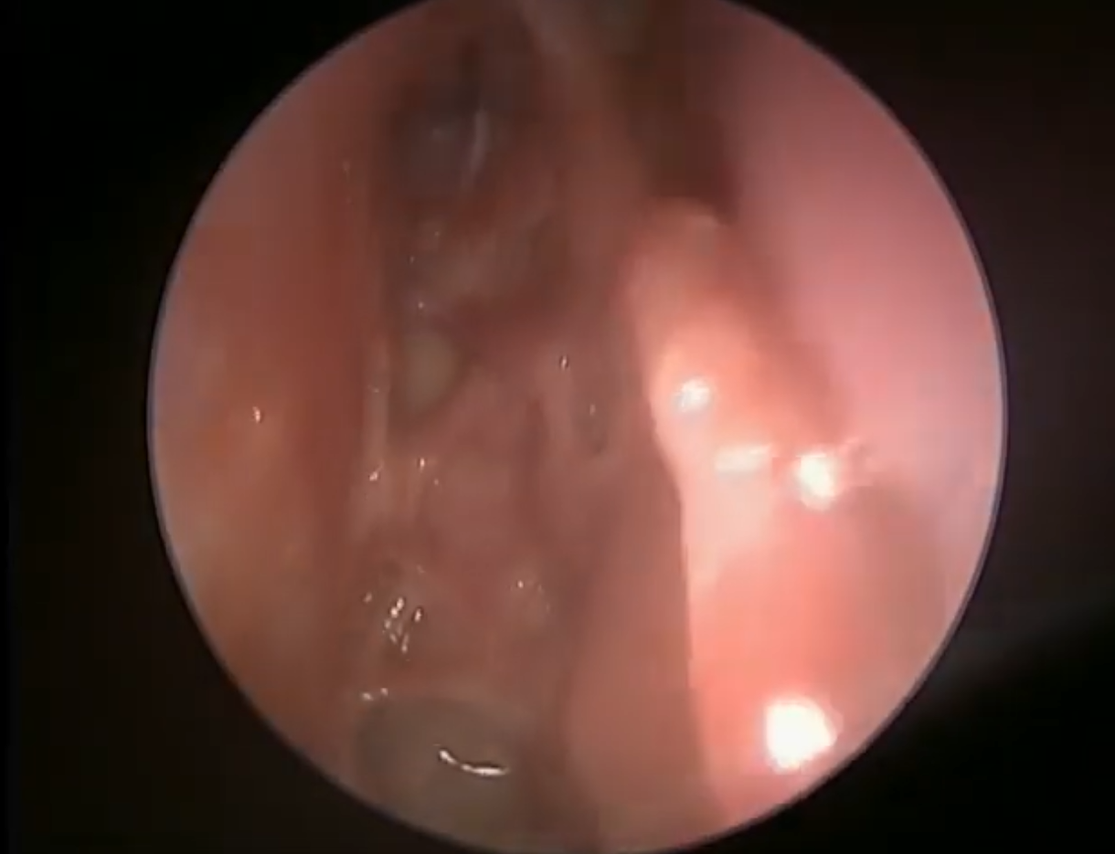 Nasal endoscopy after frontal sinus surgery video thumbnail.