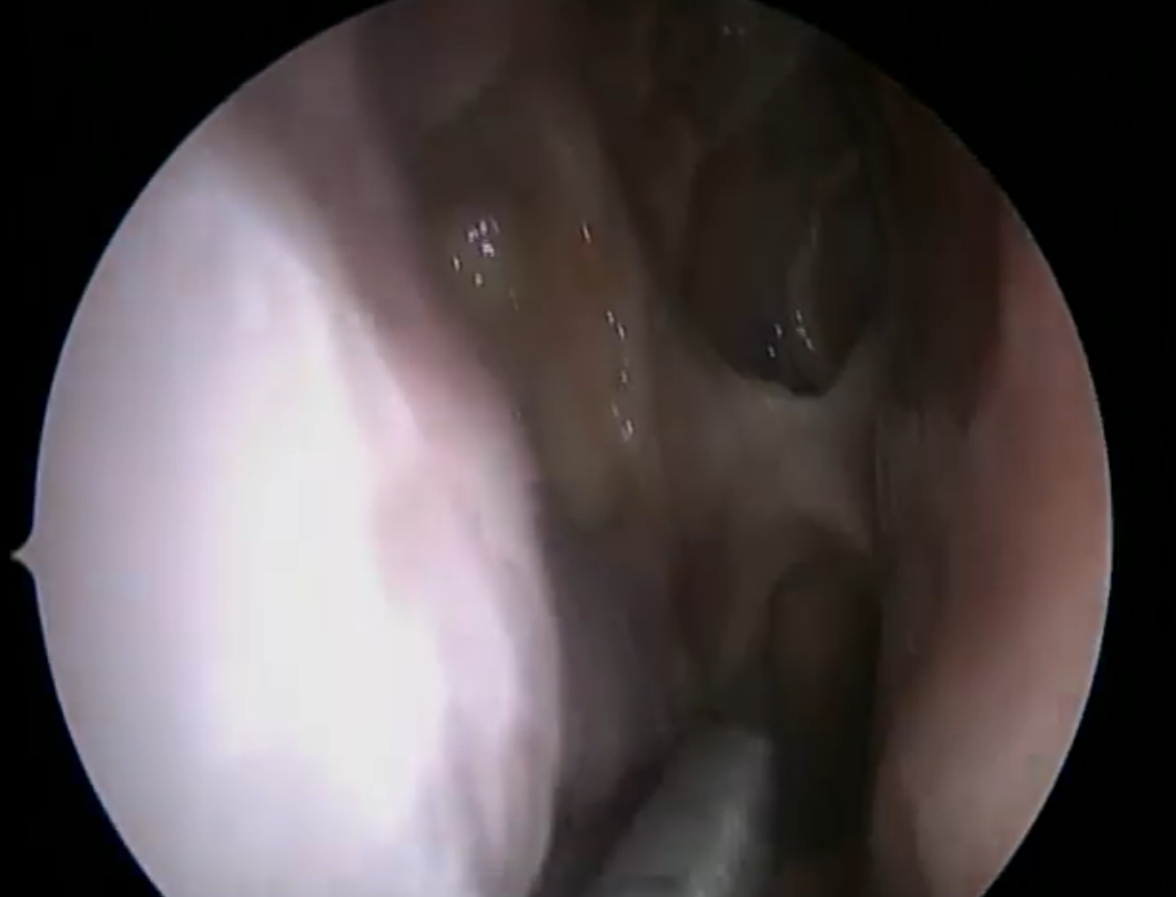 Nasal endoscopy after sinus infection cleared video thumbnail.
