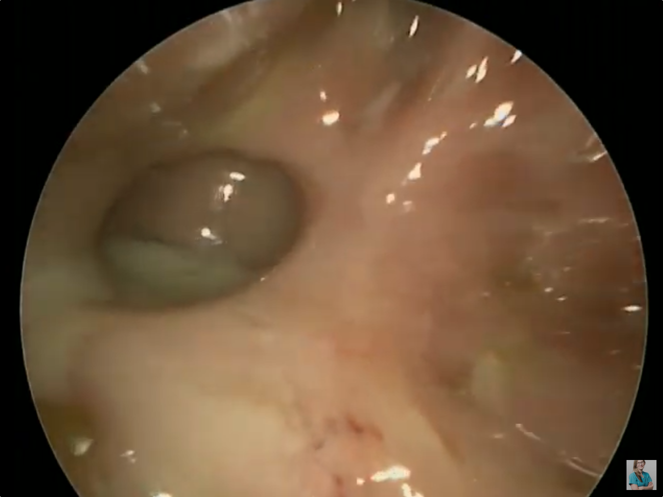 Sinus Infection - Pus in the Sphenoid Sinus video thumbnail.
