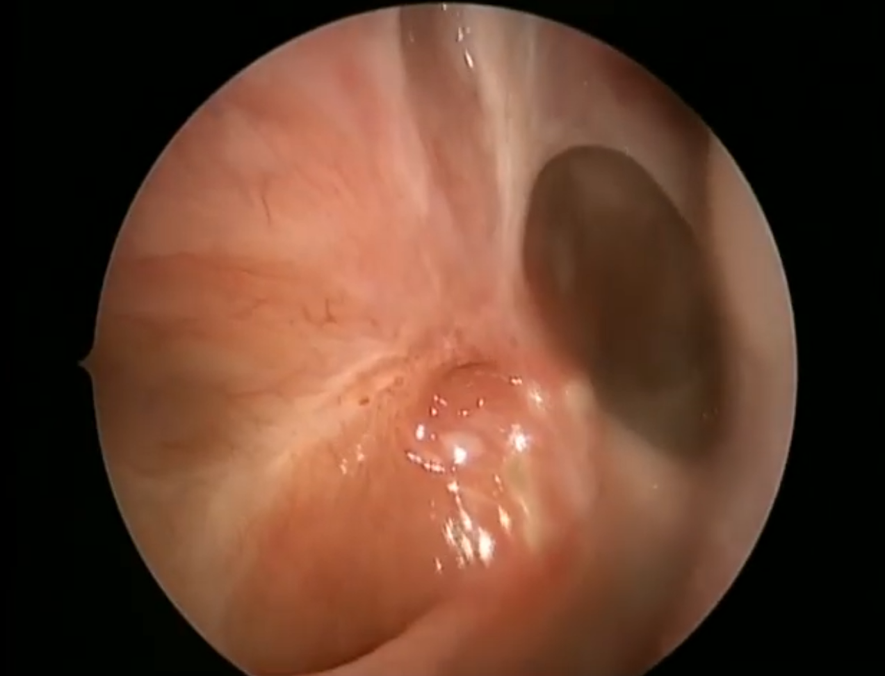 Video - Sinuses patent after sinus surgery