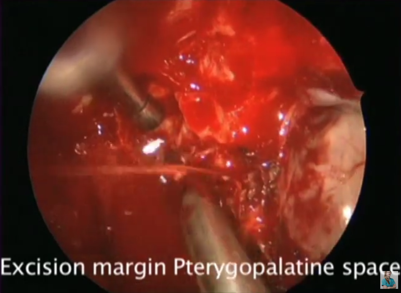 Sphenopalatine artery endoscopically video thumbnail.