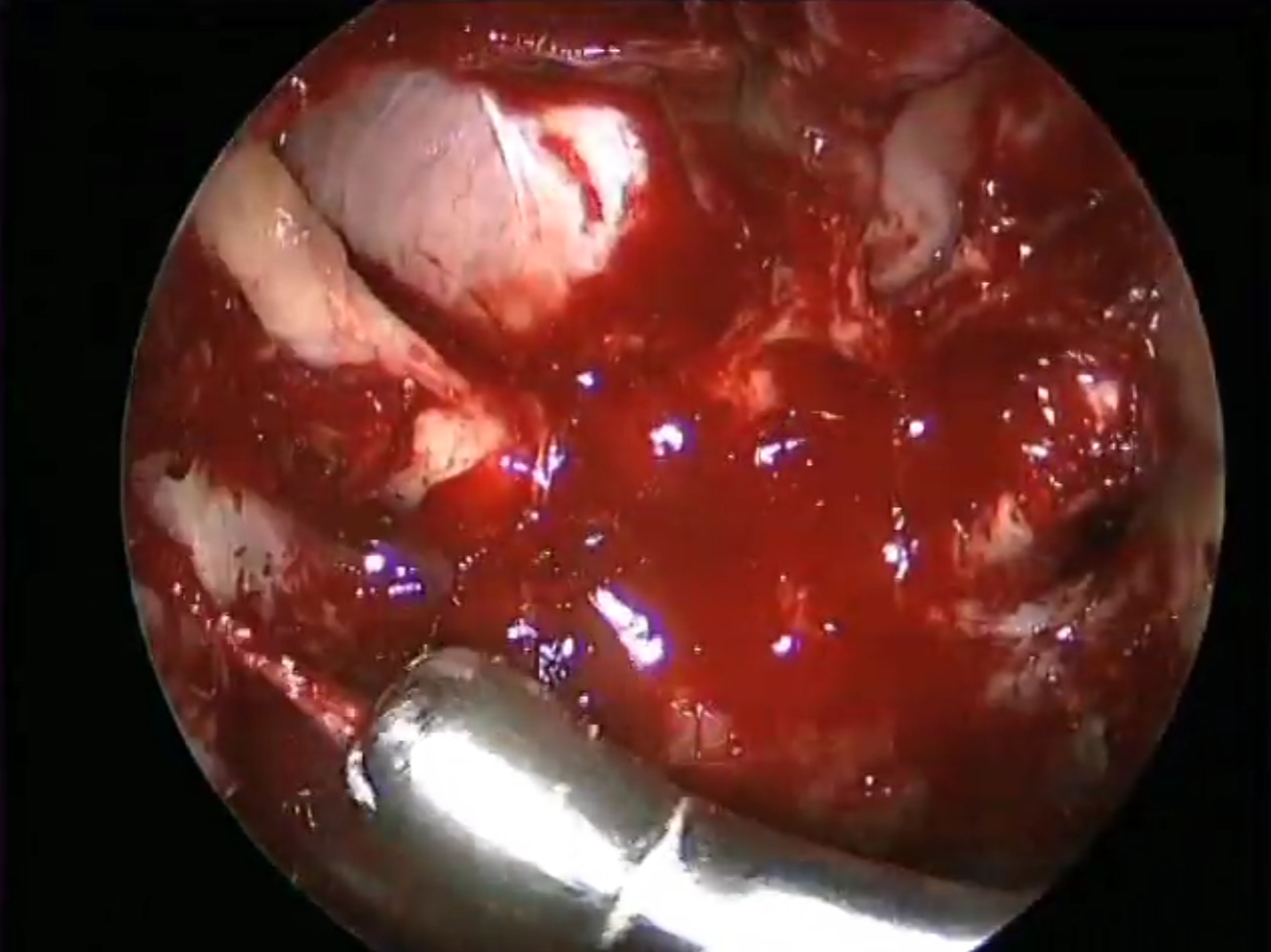 endoscopic optic nerve anatomy video thumbnail.