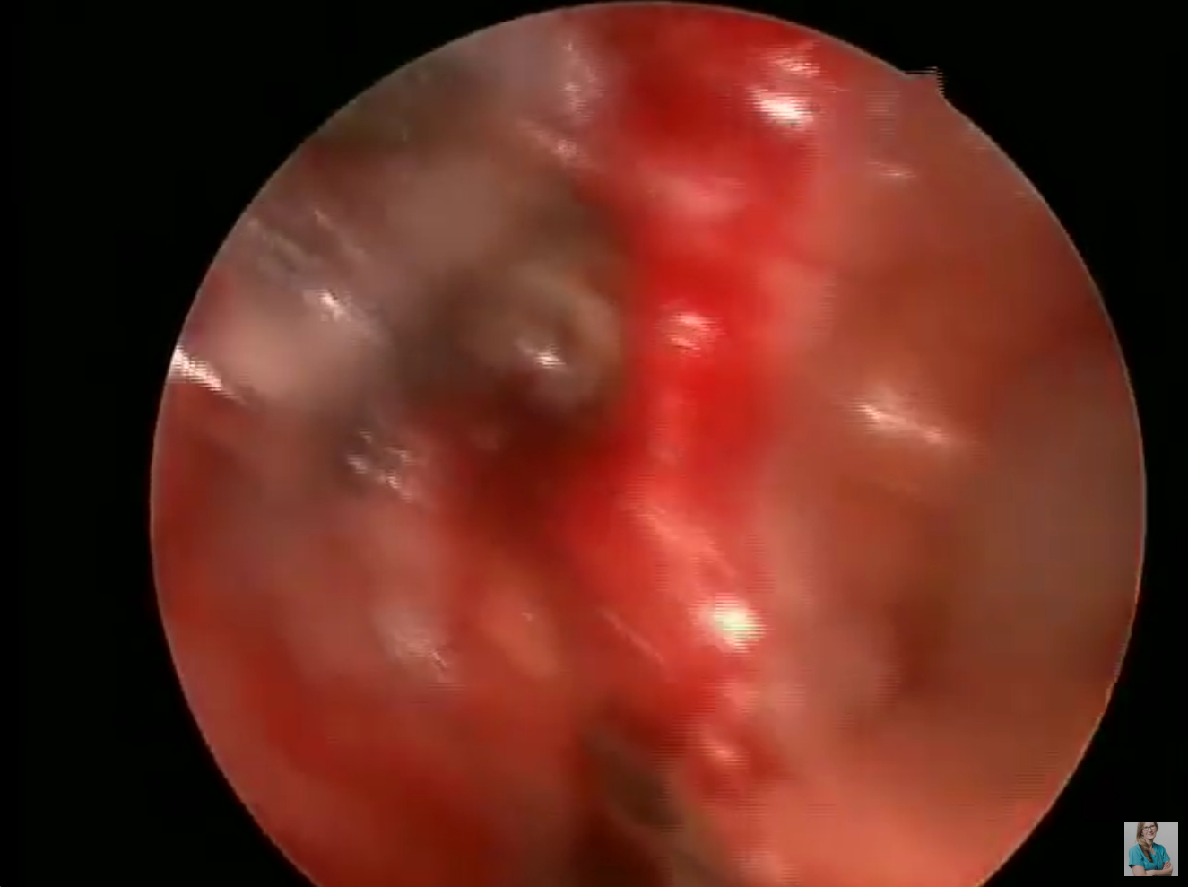 post operative nasal endoscopy after CSF leak repair video thumbnail.